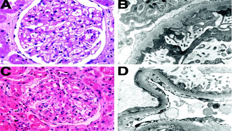 A PDF That Explains Nephritic Syndrome
